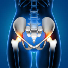 3D render of a medical female showing pain in hip joints